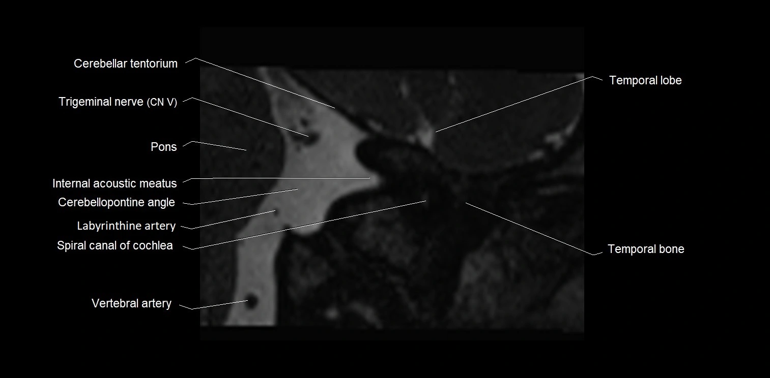 MRI Internal auditory meatus (IAM) coronal cross sectional labelled anatomy image 1.webp